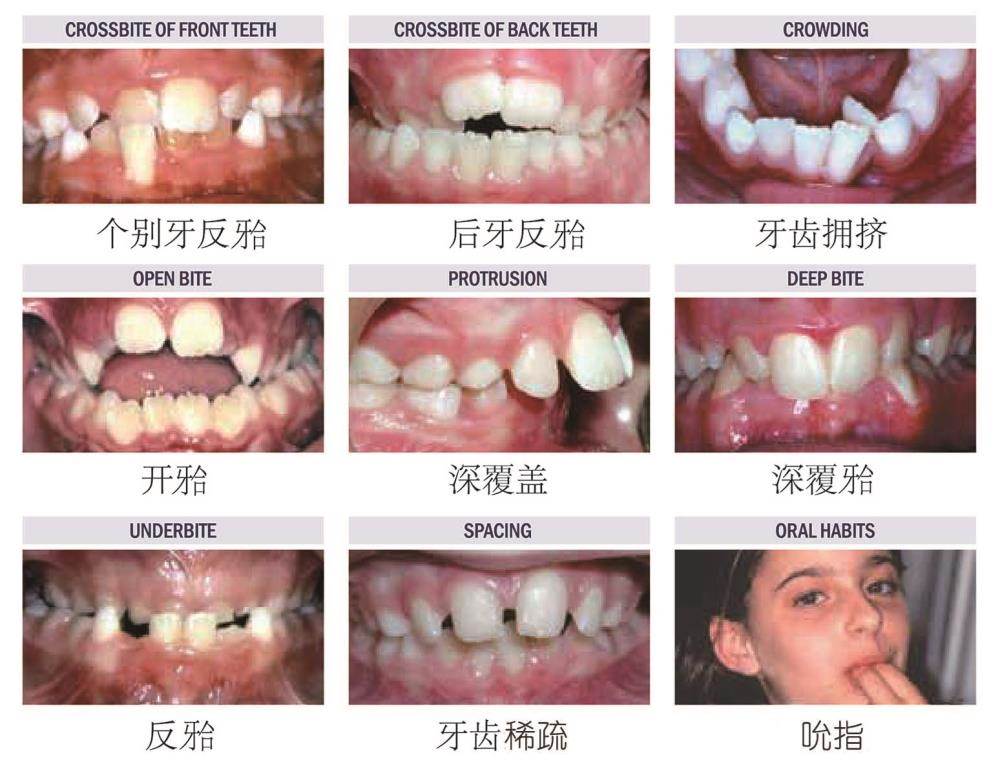 孩子牙齒不齊怎麼辦?北大兒童口腔專家葛立宏為您解答